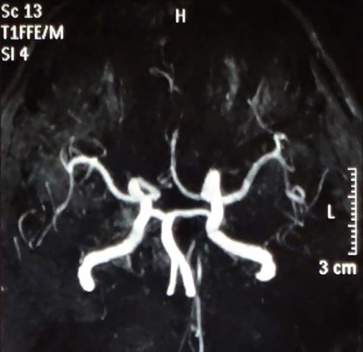 Figure 3. MRA revealing narrowing of the A1 segment of right ACA and occlusion of the A2-A3 junction of the left ACA.