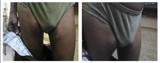 diabetes and insulin signaling case study quizlet Figure 1. Discoloration with hypertrophy on medial aspects of both thighs on the site where the patient described in Case Study 1 was injecting insulin.