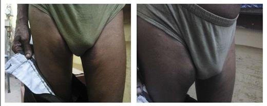 Figure 1. Discoloration with hypertrophy on medial aspects of both thighs on the site where the patient described in Case Study 1 was injecting insulin.