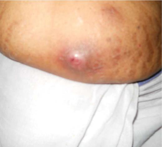 Figure 2. Insulin site abscess in patient described in Case Study 4.