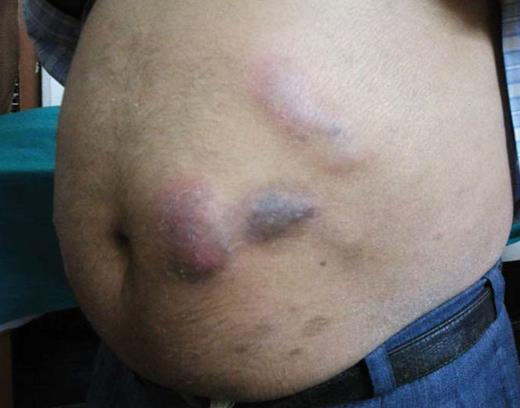 diabetes and insulin signaling case study quizlet Figure 3. Chronic granulomatous infection at injection site in patient described in Case Study 5.