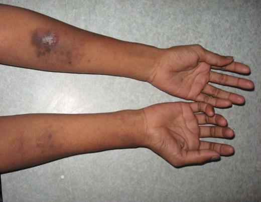 Figure 4. Forearm injection sites of the female patient described in Case Study 6.