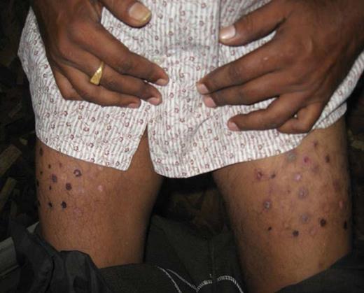 Figure 5. Post-inflammatory hyperpigmentation in the thighs of the male patient described in Case Study 7.