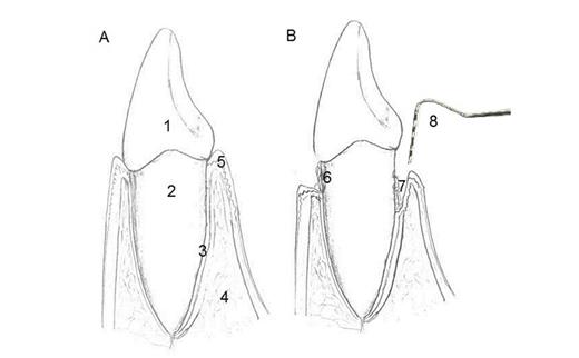 Figure 1. Diagrammatic illustration of healthy (A) and diseased (B) periodontium. The crown of the teeth is covered by enamel (1). Cementum covering the root (2), periodontal ligament (3), alveolar bone (4), and gingival attachment (5) are the four tissues that comprise the periodontium. In periodontitis subjects, dental plaque is usually seen attached to the root surface, which gets calcified over time (6), deep in the periodontal pocket (7). A periodontal probe is used clinically to diagnose periodontitis (8).