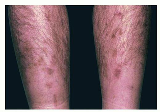 Cutaneous Manifestations of Diabetes Mellitus | Clinical Diabetes ...