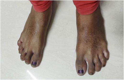 FIGURE 2. Ichthyosis on the dorsum of the feet.