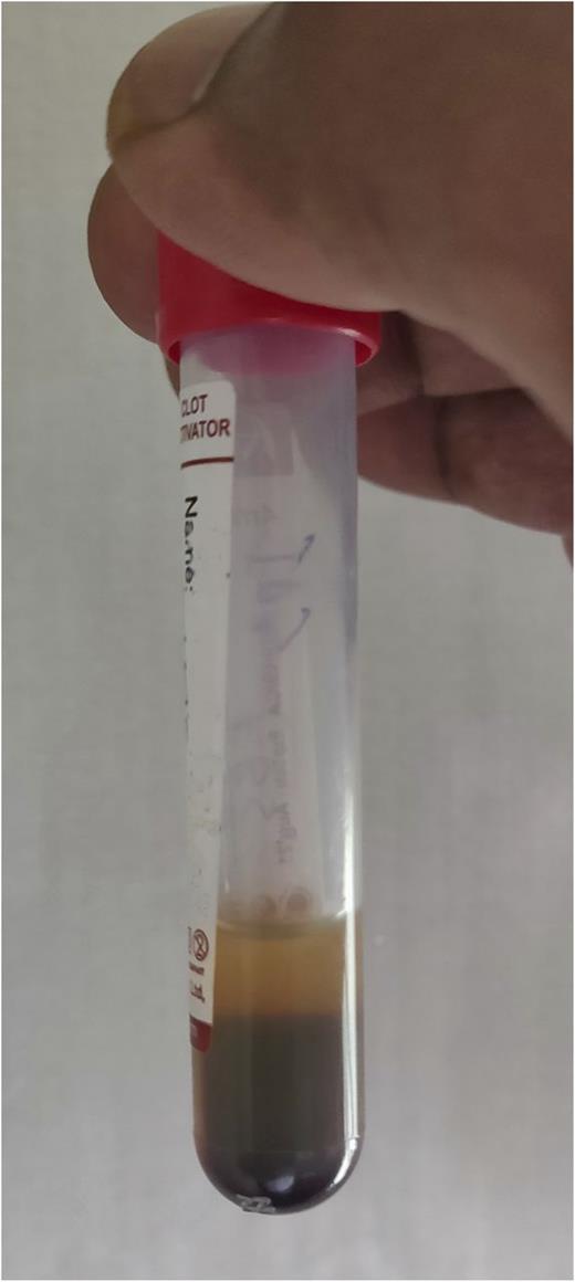 FIGURE 3. Turbid serum resulting from elevated triglycerides.