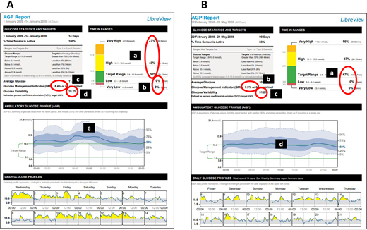 AGP reports for case study 1. A.B.’s glycemic metrics after the first 2 weeks of flash CGM (A) and after about ∼3 months of continued flash CGM use (B) are shown.