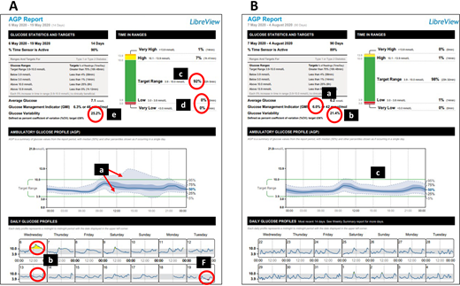 AGP reports for case study 2. N.H.’s glycemic metrics after the first 2 weeks of flash CGM (A) and after continued flash CGM use (B) are shown.
