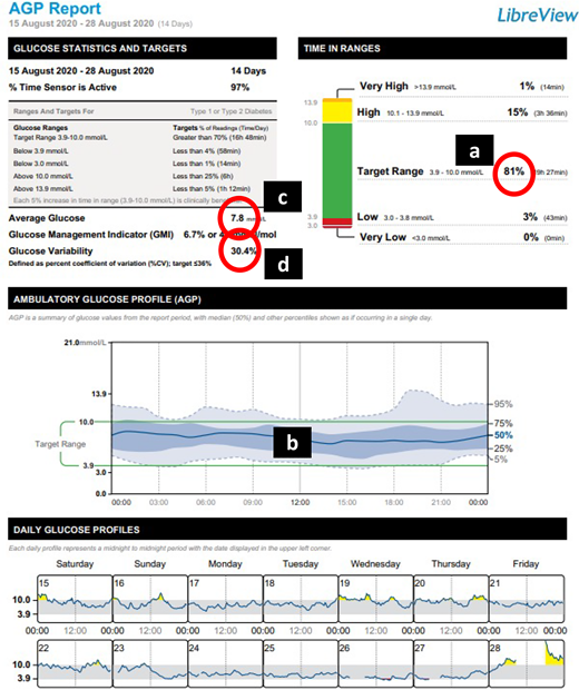 AGP for case 3. Improvements in S.M.’s glycemic metrics after initial 2 weeks of flash CGM use are shown.