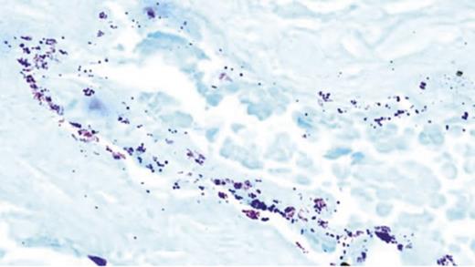 FIGURE 1. Gram stain allows visualization of bacteria within a DFU tissue sample. Gram-positive bacteria stain dark blue, gram-negative bacteria stain pink, and DFU tissue stains light blue.