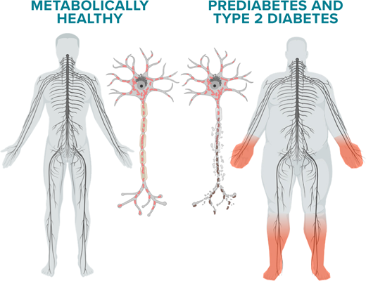 FIGURE 2. In metabolically healthy individuals (left), mitochondria produced in the neuron cell body traffic down the axons, providing energy for normal axonal function. In prediabetes and type 2 diabetes (right), the chain of injurious events leads to mitochondrial dysfunction, with adenosine triphosphatase loss and distal-to-proximal degeneration of energy-starved axons.