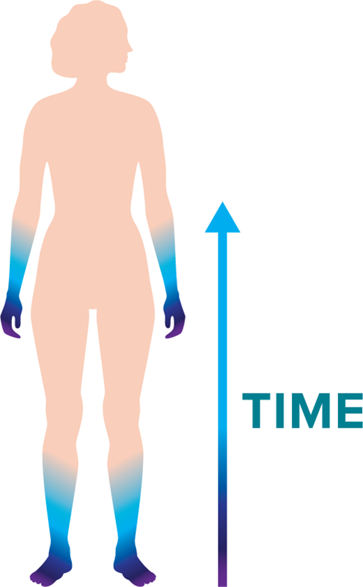 FIGURE 3. Early symptoms of diabetic peripheral neuropathy usually occur in the toes and fingertips, expanding proximally over time in a stocking-and-glove pattern. Sensations to stimuli such as vibration, pinprick, temperature, and monofilament testing all tend to diminish in this same pattern over time.