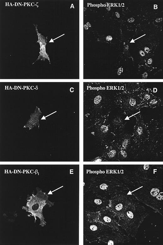 FIG. 5. Role of PKC isozymes in ET-1–induced increase of phospho-ERK1/2. MCs were grown on glass coverslips and transfected with DN-PKCs for 72 h, acutely stimulated with ET-1 (100 nmol/l for 10 min), and imaged for phospho-ERK1/2 and HA-tagged DN-PKC using dual-channel confocal immunofluorescence.