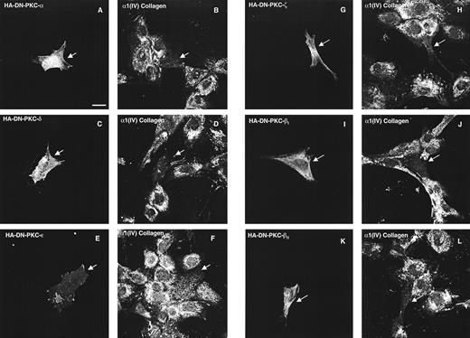 FIG. 8. Role of specific PKC isozymes in HG-enhanced ET-1 activation of α1(IV) collagen protein. Dual-channel confocal immunofluorescence images of MCs transiently transfected with DN-PKCs in HG and stimulated with ET-1 (100 nmol/l for 24 h). A– L: Double labeling of HA-tagged DN-PKCs and anti–α1(IV) collagen. Arrows indicate the cells transfected with DN-PKC and reduced α1(IV) collagen expression.