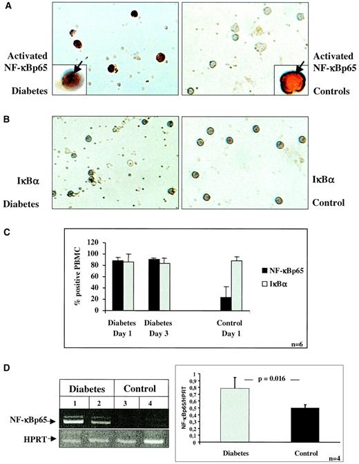 FIG. 1. Immunocytochemistry of NF-κBp65 and IκBα in circulating cells of patients with diabetes and in healthy control subjects. A: Immunocytochemistry for activated NF-κBp65 in PBMCs of a patient with newly manifested type 1 diabetes (left) and in a healthy control subject (right) (magnification: ×40). Positivity for NF-κBp65 is indicated by the dark brown color. Higher magnification (×200) of single cells demonstrated nuclear localization of NF-κBp65 in PBMCs derived from diabetic patients (left insert, arrow), whereas staining for NF-κBp65 in control PBMCs is restricted to cytoplasmic areas close to the cell wall (right insert, arrow). B: Immunocytochemistry for full-length IκBα in PBMCs of a patient with newly manifested type 1 diabetes (left) and a healthy control subject (right). Positivity for IκBα is indicated by the dark brown color. C: Compared with healthy control subjects (n = 6), staining for activated NF-κBp65 was significantly increased in PBMCs of patients with diabetes (n = 6; P = 0.0006 at day 1, diabetes versus control). In contrast, there was no significant difference in IκBα expression (P = 0.846 at day 1, diabetes versus control). NF-κBp65 and IκBα levels did not change within 3 days. D: PBMCs were isolated from four healthy volunteers and four patients with diabetes; total RNA was prepared, and 1 μg of each preparation was analyzed by RT-PCR with primers specific for NF-κBp65 (top) and HPRT (bottom), respectively. Representative RT-PCR results from two diabetic patients (lanes 1 and 2) and two control subjects (lanes 3 and 4) are shown at the left. The signal intensity of the NF-κBp65 representing band and the HPRT band was quantified by densitometry, and the ratio of NF-κBp65 to HPRT was calculated for each patient (n = 4) and each control subject (n = 4). The results are summarized at the right side.