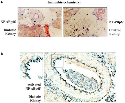 FIG. 2. Immunocytochemistry of NF-κBp65 in resting cells. A: Nine diabetic kidneys and five control kidneys were examined by immunocytochemistry with a rabbit-derived polyclonal antibody for NF-κBp65, which recognizes both the activated and the inactive protein. Selected representative stainings are shown. Blood vessel endothelia of diabetic kidneys demonstrated pronounced immunoreactivity for NF-κBp65 (left), whereas blood vessel endothelia of control kidneys showed no NF-κBp65 staining (right). Positivity for NF-κBp65 is indicated by the brown color. B: Immunocytochemistry of the above diabetic kidneys using the monoclonal antibody for activated NF-κBp65, demonstrating nuclear translocation of activated NF-κBp65 in the majority of endothelial cells (arrowheads). Positivity for NF-κBp65 is indicated by the dark brown color.