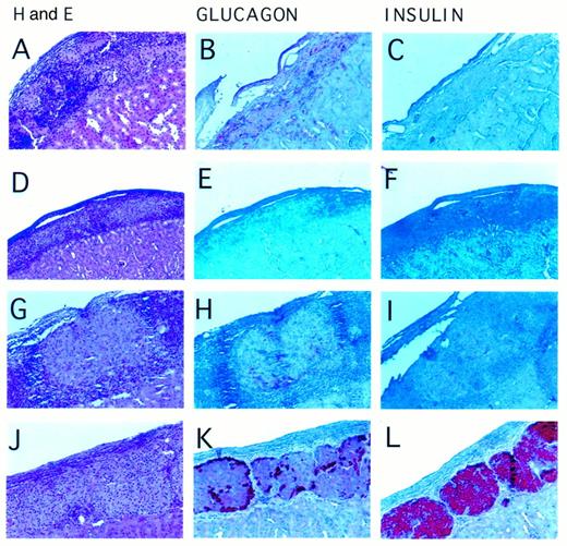 FIG. 5. Histological analysis of islet grafts in NOD mice. A: Staining of functioning allogeneic (B6) islets 10 days after transplantation into an MR1-treated female NOD recipient shows mononuclear infiltration with preservation of islet architecture (hematoxylin and eosin, 200 ×). B and C: Immunohistochemistry of syngeneic islets transplanted into a female NOD mouse treated with MR1, at the time of diabetes recurrence, shows presence of glucagon-producing cells (B, 200×) and absence of insulin staining in the graft (C, 200×). D-F: Representative graft from a female NOD recipient of B6 islets and Ha4/8, at the time of rejection (10 days), shows heavy mononuclear infiltration, disruption of islet architecture (D; hematoxylin and eosin, 100 ×), and absence of both α- (E; anti-glucagon,100 ×) and β-cells (F; anti-insulin, 100 ×). G-I: hematoxylin and eosin (G, 200 ×), glucagon and insulin staining of an islet graft from an MR1-treated female NOD recipient of allogeneic B6 islets, at the time of diabetes recurrence, shows a heavy mononuclear cell infiltrate surrounding residual islets; presence of glucagon-producing cells (H, 200 ×) and nearly complete absence of insulin staining (I, 200 ×). J-L: Staining of a functional B6 islet allograft 90 days after transplantation in a male NOD treated with MR1 shows preservation of islet graft structure and minimal cellular infiltration (J; hematoxylin and eosin, 200 ×);glucagon-producing cells confined to the periphery (K, 200 ×)and insulin-containing cells accounting for ∼80% of the islet cell mass(L, 200 ×).