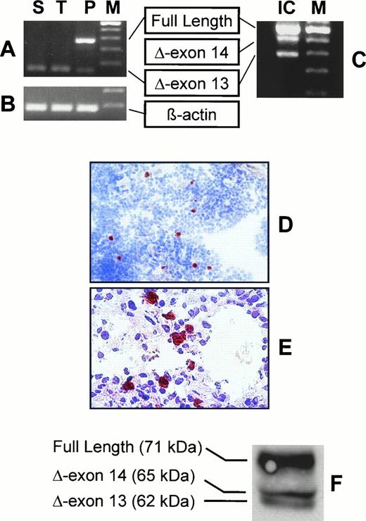 FIG. 2. Alternative splicing of the IA-2 gene and IA-2 protein expression. Panel A: IA-2 mRNA transcripts amplified with primers IA-2-F and IA-2-R (370 bp, full-length; 151 bp, Δ exon 13 transcript) from total RNA samples extracted from spleen (S), thymus (T), and pancreas (P). The molecular weight marker (M) bands shown correspond to 600, 500, 400, 300, and 200 bp, top to bottom. Note that all tissues were from the same subject (case 3444). Panel B: β-actin mRNA (439 bp) amplified from the same samples in panel A (28 PCR cycles). The molecular weight marker (M) bands shown correspond to 500 and 400 bp, top to bottom. Panel C: IA-2 mRNA transcripts amplified with primers IA-2-F and IA-2–R2 (617 bp, full-length; 488 bp, Δ exon 14 transcript; 398 bp, Δ exon 13 transcript) from total RNA extracted from purified pancreatic islet cells (IC) (case 999). The molecular weight marker (M) bands shown correspond to 700 (partially shown), 600, 500, 400, 300, and 200 bp, top to bottom. Panel D: Frozen section of human thymus stained with an antibody recognizing the intracellular portion of the ICA512 (IA-2) molecule (aa 601–979). Sparse cells in the thymus medulla are stained in red (with AEC), and thus they express IA-2 protein. Counterstained with hematoxylin, magnification ∼128×. Similar results were obtained using an antibody against the extracellular portion of the molecule (not shown). Panel E: Frozen section of human spleen stained with an antibody against the extracellular portion of the ICA512 (IA-2) molecule (aa 389–576). Sparse cells expressing IA-2 are stained in red (with AEC). Counterstained with hematoxylin, magnification ∼200×. Similar results were obtained using an antibody against the intracellular portion of the molecule (not shown). Panel F: Western blot of pancreas protein extracts showing three bands of the predicted size for the IA-2 protein variants encoded by the full-length and alternatively spliced transcripts.