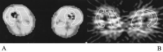 FIG. 2. ROIs were identified on the medial and lateral thigh muscles on the coregistered CT-transmission scan (A) and then applied to dynamic PET images (B).