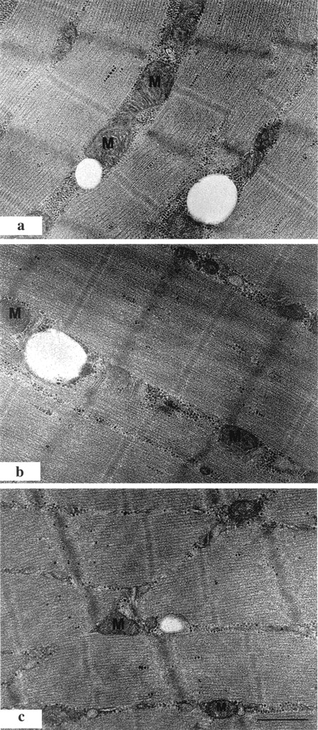 FIG. 4. Representative electron micrographs of skeletal muscle from a lean volunteer (a), an obese volunteer (b), and a volunteer with type 2 diabetes (c). The bar in the bottom right corner of c is 0.5 μm. Several mitochondria are labeled with the letter M.