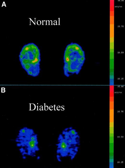 FIG. 4. 6-[18F]Fluorodopamine PET scans of feet of a normal subject (A) and of a patient with diabetes (B).