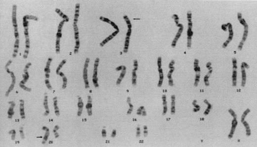 FIG. 1. Karotype of proband 46, XX t(3;20) (p21.2;q12). Cytogenetic analysis shows a balanced reciprocal translocation between the short arms of chromosome 3 and the long arm of chromosome 20. Arrows point to the two derivative chromosomes.