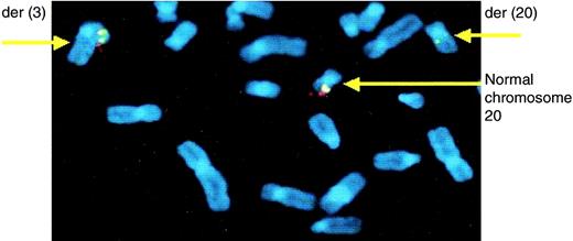 FIG. 2. Metaphase-arrested spread with triple hybridization of chromosome 20q telomere probe, PAC 207N8, and PAC 113E14. Chromosomes are counterstained with DAPI (blue), the chromosome 20q telomere probe was labeled with Texas Red (red), PAC 113E14 was labeled with FITC (green), and PAC 207N8 was labeled with Cy5 (pseudocolored orange). There are three signals on the normal chromosome 20 and on one of the derivative chromosomes; on the second derivative chromosome, there is only signal from the green PAC 113E14 probe.