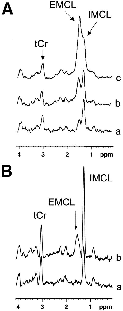 FIG. 1. A: Representative volume of selective in vivo 1H-MR spectra at 7 Tesla of the M. tibialis anterior of an obese ZDF rat (20 weeks old, ∼470 g) derived from different volume sizes: 4 mm3, 1,024 averages (a); 8 mm3, 512 averages (b); and 18 mm3, 256 averages (c). Reduction of the selected volume diminishes the EMCL signal at 1.5 ppm and facilitates the quantification of IMCL at 1.3 ppm. Spectra were referenced to the tCr resonance at 3.05 ppm. B: Representative volume of selective in vivo 1H-MR spectra at 7 Tesla of the M. tibialis anterior of a lean ZDF rat (a) and an obese ZDF rat (b). Both rats were ∼8 weeks old. Volume: 8 mm3. Note the elevated IMCL-to-tCr integral ratio in the spectrum of the obese ZDF rat as compared with the lean littermate.