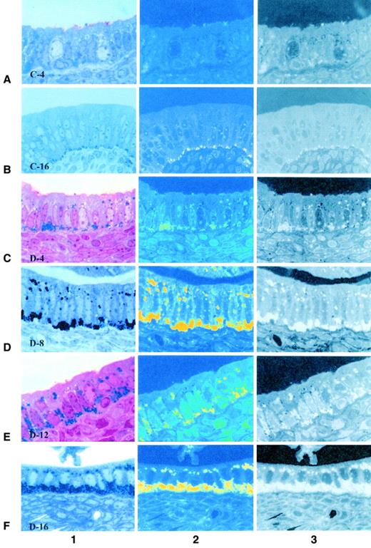 FIG. 2. Photomicrographic (×1000) analysis of cytoplasmic lipid vacuole accumulation and distribution patterns in 4- to 16-week-old control (+/?; C) and diabetic (db/db; D) groups (rows A−F) using light (column 1), digital photochemical intracellular lipid enhancement (column 2), and digital lipid subtraction (column 3) techniques for the determination of temporal and progressive volume alterations in diabetes-associated cytolipoatrophy of endometrial periluminal epithelial cells. The typical patterning of basal cytoplasmic lipid vacuole accumulations are presented from 4- (row A; C4) and 16-week-old (row B; C16) control group photomicrographs. Basal pole lipid (column 1: blue stain; column 2: fluorescent yellow) characterized subnuclear cytoplasmic regions in control epithelial cells during the age duration of the experiments and remained relatively constant in both volume and distribution patterns. In contrast, the enhanced basal pole lipid accumulations observed in the young (age 4 weeks) db/db endometrial epithelial samples (row C; D4) continued to increase in volume (rows D [D8] and E [D12]) in db/db groups ages 8 and 12 weeks. Perinuclear and supranuclear cytoplasmic distribution patterns were pronounced in all db/db samples relative to controls (C4, C16). By age 16 weeks (row F; D16, columns 1 and 2), pronounced epithelial cytohyperlipidemia was exhibited throughout the periluminal epithelial cell layer of diabetic endometrial tissue samples.