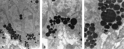 FIG. 5. Electron photomicrographic (×25–35 k magnification) analysis of basal pole lipid accumulation and cytoplasmic perinuclear and apical migration of lipid vacuoles in endometrial periluminal epithelial cells of diabetic (db/db) C57BL/KsJ mice ages 8–16 weeks (A). Pronounced basal membrane folding, peristromal isolation and separation, and the intracytoplasmic dispersion of lipid vacuoles characterized the db/db tissue sample profiles. The progressive expansion of vacuole volumes (B) and density appeared as a migration of basal membrane stromal transmembrane accumulations, subjected to hydrophobic migration from the basal pole toward subnuclear sites, where lipophilic expansion occurred. The transmembrane movement of stromal lipid pools into basal cytoplasmic regions (C; closed arrows) along the epithelial peristromal surface in db/db tissues accounted for the progressive expansion of the cytoplasmic volume occupied by lipid vacuoles. Lipophilic attractions (C; open arrows) between adjacent vacuoles probably accounted for the massive basal pole accumulations before the intracytoplasmic traffic dispersion of vacuoles toward perinuclear and apical cytoplasmic regions.