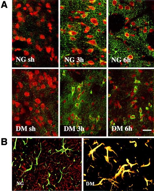 FIG. 2. Double-immunostained confocal images for cytochrome c in nondiabetic normoglycemic (NG) and diabetic (DM) rats in the striatum subjected to sham-operation (sh) or to 30 min transient focal ischemia followed by 3 and 6 h of recovery. A: Cytochrome c release in neurons. NeuN, a marker for neuron cells, is stained with red fluorescence and cytochrome c is stained with green fluorescence. Overlay of red and green generates yellow color. Cytosolic cytochrome c release is evident in diabetic sections after 3 and 6 h of reperfusion while it is faint in nondiabetic sections. B: Cytochrome c localization in glia cells after 3 h of recovery. Glial cells are marked with green fluorescence and cytochrome c with red. Cytochrome c colocalizes with GFAP-positive glial cells, as reflected in yellow color, in diabetic but not in nondiabetic sections. Bar = 50 μm.