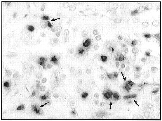 FIG. 7. Pancreatic tissue section from a human with type 2 diabetes stained for apoptosis using the TUNEL method. Arrows indicate pairs of apoptotic β-cells, suggesting postmitotic β-cell apoptosis. To illustrate the phenomenon of pairs of TUNEL-positive cells, the figure depicts an example with a high number of apoptotic cells. Recently, we reported that in autopsy material from humans with type 2 diabetes, the mean is 0.5 ± 0.2 apoptotic cells/islet ranging from 0 to 46 cells/islet (3).