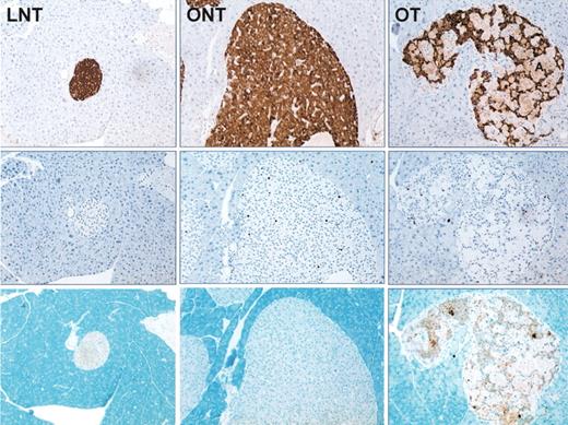 FIG. 3. Islet morphology (sections of mouse pancreas, magnification ×10). The left column shows a typical islet from a lean nontransgenic (LNT) mouse; the central column shows a typical islet from an obese nontransgenic (ONT) mouse; the right column shows a typical islet from an obese transgenic (OT) mouse. The top panels are stained for insulin, the middle panels are stained for replication using the Ki67 marker, and the bottom panels are stained for apoptosis using the TUNEL method. Increased islet size is seen in islets from both OT and ONT mice, with extensive amyloid deposits in the islet from the OT mouse. Numerous replicating cells are present in islets from the obese mice (OT and ONT), although none are present in the islet from the lean mouse (LNT; middle). Numerous apoptotic cells are evident in the islet from the OT mouse, as opposed to the islets from nontransgenic mice (LNT, ONT), where apoptosis was a rare event and is not seen in these representative islets (bottom).