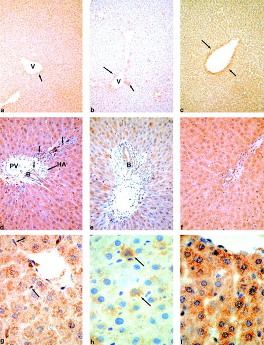 FIG. 3. Immunohistochemical localization of OGT antigen in rat liver. All sections reacted with HRP-DAB system (see research design and methods). The reaction product demonstrating the localization of the antigen is brown. Sections counterstained with hematoxylin are blue. a: Normal rat liver. All hepatocytes contain OGT. The hepatocytes surrounding a central vein (V) have a slightly more intense reactivity (arrow). b: Untreated diabetic rat liver. There is a dramatic loss of reactivity compared with the normal liver. Most hepatocytes have no demonstrable OGT antigen. Only a few lobular hepatocytes and the perivenular (V) ones (arrows) contain some demonstrable antigen. c: Insulin-treated diabetic rat liver. All hepatocytes are staining with an intensity similar to that of normal rat hepatocytes. The preferential staining of perivenular hepatocytes (arrows) is clearly demonstrated. Magnification for a, b, and c was ×100. d: Normal rat liver; detail of portal area. All hepatocytes have a positive reaction. The bile ductule cells (B) are also intensely positive. Endothelial cells lining the portal vein (PV), hepatic artery (HA) radicles, and vascular smooth muscle cells are negative. A few interstitial cells in the portal space (arrows) are positive. e: Untreated diabetic rat liver; detail of portal area. Only a few hepatocytes have some positivity. Bile ductule cells (B) and even the interstitial cells have notable weaker staining. f: Insulin-treated diabetic rat liver; detail of portal area. The staining of all cell types, hepatocytes, ductular, and interstitial cells is similar to that in the normal rat liver. Magnification for d, e, and f was ×200. g: Normal rat liver, detail of central region. Hepatocytes have an intensely positive reaction. The staining is not homogeneous throughout the cytoplasm, but clearly granular, suggesting OGT is confined in some subcellular compartment. Sinusoidal lining cells (either Kupfer or endothelial cells) are negative (arrows). h: Diabetic rat liver, detail of central region. Only two hepatocytes (arrows) in this field are positive. At this magnification the multiple intracellular lipid vesicles (steatosis) common in uncontrolled diabetes are obvious. All nonparenchymal cells are negative. i: Insulin-treated diabetic rat, detail of central region. All hepatocytes have the same intense, granular staining. There is no steatosis. Nonparenchymal cells are negative. Magnification for g, h, and i was ×400.