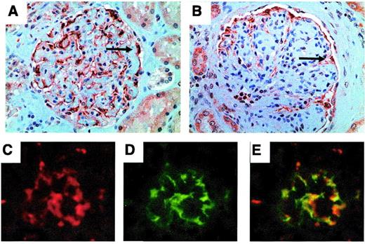 FIG. 6. Immunohistochemical localization of HSD3B4 in human and mouse control and diabetic kidneys. Podocytes and tubular epithelial cells stain positive (brown) with rabbit anti-HSD3B4 antibody in control human kidney tissue (A) and in kidneys with advanced diabetic nephropathy (B). Nuclei were counterstained with hematoxylin. HSD3B4 colocalized with podocyte marker synaptopodin in mice (C–E). Frozen control (4-week-old 129 SvJ) mouse kidney sections were stained with anti-HSD3B4 (red) (C) and anti-synaptopodin (green) (D) and their overlap (E). The arrows show positive HSD3B4 staining in podocytes.