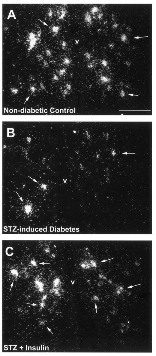 FIG. 2. Darkfield photomicrographs showing representative sections of the ARC and GALP mRNA-expressing neurons (as reflected by the presence of white clusters of silver grains) from normal controls (citrate + saline; A), STZ-induced diabetics (STZ + saline; B), and STZ-induced diabetics treated with insulin (STZ + insulin; C). Arrows indicate examples of silver grain clusters denoting GALP mRNA expressing neurons. V, third ventricle; bar = 100 μm.