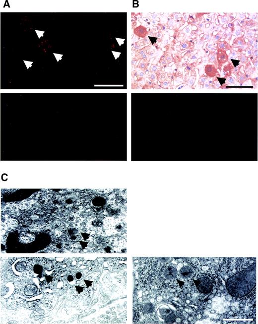 FIG. 7. Adenoviral PDX-1/VP16 expression in the liver, together with NeuroD or Ngn3, induces insulin protein. A: To examine insulin protein expression in the liver, we performed immunostaining for insulin after the adenovirus injection. Insulin immunostaining 3 days after treatment with Ad–PDX-1/VP16 plus Ad-NeuroD is shown (upper panel). Several insulin-positive cells (arrows; red cells) were clearly observed in cytoplasm. In contrast, insulin was not detected at all in the control liver (left lower panel) or by immunostaining without primary antibody (right lower panel). Bar, 20 μm. B: To examine insulin processing in the liver, we performed immunostaining for C-peptide after the adenovirus injection. The panel shows C-peptide immunostaining 3 days after treatment with Ad–PDX-1/VP16 plus Ad-NeuroD. Several C-peptide−positive cells (arrows; brown cells) were clearly observed. Bar, 20 μm. C: To further evaluate insulin biosynthesis in the liver, we performed electron microscopy. The panel shows an electron microscopy in the liver 3 days after treatment with Ad–PDX-1/VP16 plus Ad-NeuroD. Several insulin secretory granules (arrows in left upper and lower panels) were observed. Peroxisome was observed even in control liver (arrowheads in right panel) but was different from insulin secretory granules.