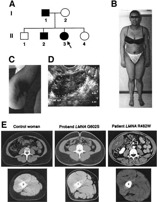 FIG. 1. Clinical characteristics of the propositus. A: Pedigree subjects bearing the LMNA G602S mutation are represented as filled symbols. The propositus is indicated by an arrow. B: Anterior view. C: Axillary acanthosis nigricans. D: Enlarged polycystic left ovary, transvaginal sonography. E: Cross-sectional computed tomography at the level of the L4 vertebra and the mid-thigh in a control woman, the proband, and a woman with typical FPLD due to the LMNA R482W mutation and similar BMI (22.8, 23.2, and 23.1 kg/m2, respectively).