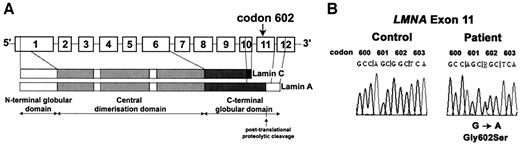 FIG. 3. Molecular studies. A: Schematic representation of the LMNA gene and its main protein products, with the position of the patient’s mutation. B: Genetic analysis of the LMNA gene in the proband. DNA sequence analysis from codons 600 to 603 of LMNA, showing a heterozygous G to A transition at position 5513 (exon 11) in the proband, predicting a G602S substitution.