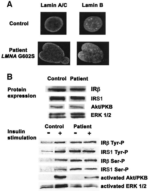 FIG. 4. Immunofluorescence (A) and insulin signal transduction (B) studies in cultured fibroblasts. A: Alterations of the proband’s fibroblast nuclear shape and lamina structure. Fixed fibroblasts were labeled with antibodies against lamin A/C and lamin B, and more than 400 control and patient cells were analyzed by conventional immunofluorescence microscopy, as previously described (18). Six percent of the patient cells and none of the control cells had dysmorphic nuclei, with herniations lacking lamin B staining, while the lamin A/C signal was heterogeneous. Bar = 10 μm. B: Insulin signal transduction defects in the proband’s cells, as assessed by Western blot analysis. Cells from control subjects and the proband contained a normal amount of IRβ and its molecular effectors IRS-1, Akt/PKB, and ERK1/2. IRβ and IRS-1 showed increased basal tyrosine and serine phosphorylation in the proband’s cells and did not respond to insulin. Akt/PKB and ERK1/2 activation in response to insulin was blunted in the proband’s cells.