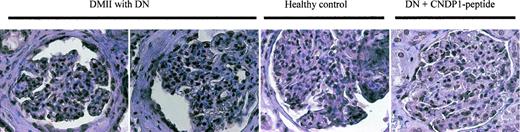 FIG. 4. Human kidney specimen from patients with diabetic nephropathy (DMII with DN) and control individuals (Healthy control) were stained for CNDP1. In the kidneys with diabetic nephropathy, there is increased staining in the glomerulus and in parietal epithelial cells. Representative stainings using the C17E antibody are depicted. A C17E antibody preincubated with the respective peptide was used as control (last panel).