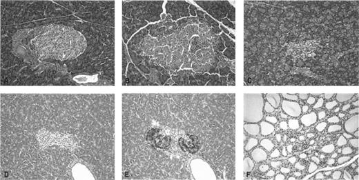 FIG. 1. Islet and thyroid pathology in LEW.1WR1 rats. A: Normal islet from a 120-day-old nondiabetic animal. B: 3+ insulitis in a 120-day-old nondiabetic animal. C: End-stage islet with minimal residual inflammatory infiltrate from a spontaneously diabetic animal obtained 2 h after detection of hyperglycemia. D and E: Immunohistochemical analysis of adjacent sections of an islet obtained from an animal that had been diabetic for 2 days. D: Absence of detectable insulin-containing cells. E: Abundant glucagon-containing cells. F: Histologically normal thyroid gland obtained from the same animal. A–C and F: Hematoxylin-eosin. Final magnification in all panels, ×133. A color version of this figure is available online (supplemental Fig. 3).
