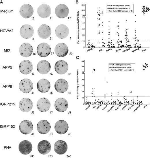 FIG. 2. Recognition of β-cell peptides by HLA-A2–restricted CD8+ T-cells from recent-onset type 1 diabetic patients. A: Representative ELISpot assay (triplicate wells) demonstrates IFN-γ responses to a peptide mix (CMV + EBV + Flu, positive control) and to individual β-cell peptides, including IAPP5, IAPP9, IGRP215, IGRP152, and PHA (positive control). Wells containing medium alone (Medium) and HCV peptide (HCV/A2) served as negative controls. B and C: CD8+ T-cell responses to the indicated β-cell peptides are expressed as the absolute mean numbers of antigen-specific IFN-γ–positive spots per 2 × 105 PBMCs derived from HLA-A*0201 recent-onset type 1 diabetic patients (○), nondiabetic HLA-A*0201 control subjects (▴), and non–HLA-A*0201 control subjects (⋄). A threshold of 12 spots per 2 × 105 cells (horizontal dotted line) was established as a cutoff for a positive result based on the ELISpot responses to the peptides that were at least 2 SDs above the mean of the nondiabetic control subjects. The peptide-specific responses are shown in two separate panels (B and C) for clarity. PHA, phytohemagluttinin.