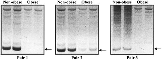 FIG. 1. Representative agarose gels (three different nonobese and obese matched pairs) showing a differentially expressed band (decreased in obese subjects) corresponding to MMP3 (arrow). For differential-display PCR, the cDNA samples were amplified in duplicate using MMP3 mRNA–specific primers.