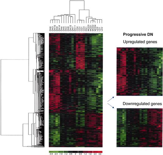FIG. 2. Hierarchical cluster analysis of gene expression profiles from renal biopsies with early or progressive DN and different controls. Tubulointerstitial compartments of renal biopsies from patients with DN (n = 13) and MCD (n = 4), as well as pretransplant biopsies from related LD (n = 3) and CD (n = 4) kidneys, were analyzed. For clinical and histological patient characteristics, see Table 1. Gene expression profiles were analyzed using Affymetrix oligonucleotide arrays HGU133A. Of the 22,283 probe sets, 10,183 probe sets (45.7%) were expressed above background signal. Each row represents a gene; each column represents a biopsy. Transcript abundance is displayed on a red-green color scale, with red expression above and green below the median. Using the SAM algorithm, a multiple comparison analysis of LDs, CDs, MCD, and early and progressive DN with an FDR of 1% detected differential regulation of 1,349 from the 10,183 expressed probe sets. The cluster dendrogram sorts the patients with the most similar gene expression profiles together with the shortest branches. Hierarchical clustering showed three principal branches of DN, CD, and MCD/LD, with the earliest DN (DN1) as the only outlier in the MCD/LD cluster. Differentially regulated mRNAs are provided in the online appendix.