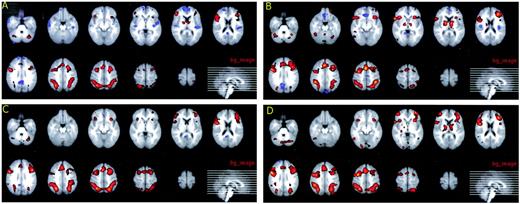 FIG. 2. Red to yellow represents activation, and light blue to dark blue represents deactivation of brain activity. A: (de)activation no–diabetic retinopathy euglycemia 2-back>0-back. B: (de)activation diabetic retinopathy euglycemia 2-back>0-back. C: (de)activation no–diabetic retinopathy hypoglycemia 2-back>0-back. D: (de)activation diabetic retinopathy hypoglycemia 2-back>0-back.