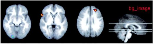 FIG. 3. Diabetic retinopathy euglycemia/hypoglycemia>no–diabetic retinopathy euglycemia/hypoglycemia 2-back>0-back. Blue (left occipital lobe): diabetic retinopathy hypoglycemia>no–diabetic retinopathy hypoglycemia. Red (right superior frontal gyrus): diabetic retinopathy euglycemia>no–diabetic retinopathy euglycemia.