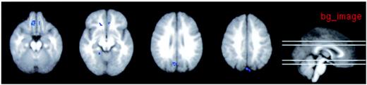 FIG. 4. Diabetic retinopathy hypoglycemia > euglycemia 2-back>0-back.