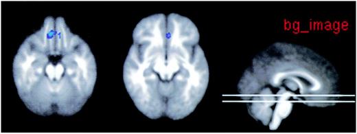 FIG. 5. Diabetic retinopathy>no–diabetic retinopathy (hypoglycemia> euglycemia) 2-back>0-back.